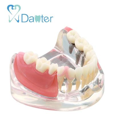 China Hospital Clinic University New Design Dental Implant Model With Restoration Dental Teaching Model for sale