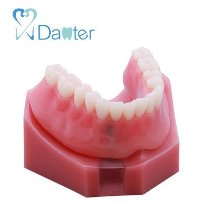 China Newest Hospital Clinic University Overdenture Model With 2 Implants Dental Model For Demonstration for sale