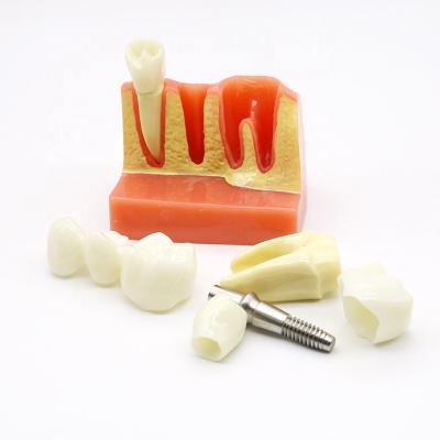 China Medical School.hosptical dental implant teeth models for sale