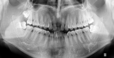 China Filme diagnóstico médico impermeável feito sob encomenda da imagem latente X Ray para a impressora térmica à venda