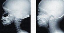 Cina Alta rappresentazione diagnostica di copertura X Ray dell'inchiostro, lastra radioscopica medica del laser di 43cm x di 35 in vendita