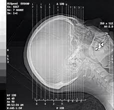 Chine La représentation diagnostique du laser X Ray d'halogénure d'argent, A3/A4 imperméabilisent le film de transparent à vendre