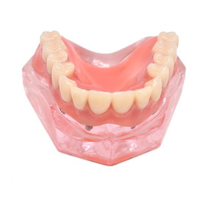 China Dental Regional Denture Removable 4 Pin Dental Implant Restoration Pink Submandibular Model for sale