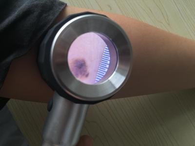 China Haut-Scanner-Lupe Krankenhaus Viedo Dermatoscope auf Haut und Haar zu verkaufen