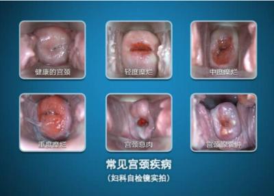 China Hochauflösender elektronischer Colposcope-tragbares Gerät Anzeigen-Digital, zum des Halses und des Vagin zu überprüfen zu verkaufen