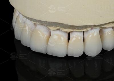 Cina Colore naturale dei denti Veneer ceramico feldspatico per denti anteriori e posteriori in vendita