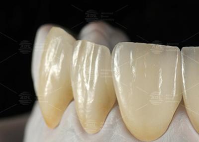 China 0.3mm-0.7mm Feldspatische EMAX Keramik Veneers Natürliche ästhetische Emax Zahn Veneers zu verkaufen