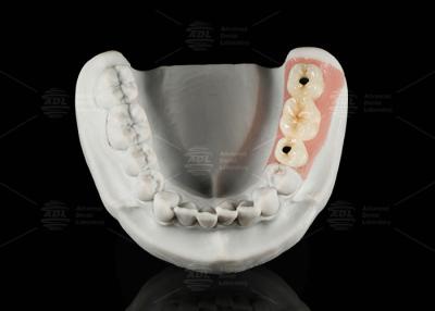 Cina Porcellana di titanio ad abitazione personalizzata fusa in zirconia in vendita