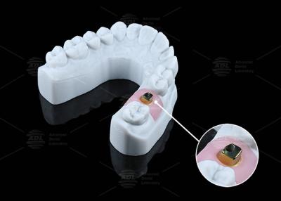 China Op maat gemaakte tandheelkundige implantaten en oplossingen tegen corrosie op basis van titanium Te koop