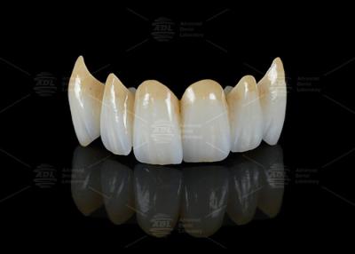 Chine Haute translucideur de plein contour Zirconia Bridge Résistance aux fissures Esthétique naturelle à vendre