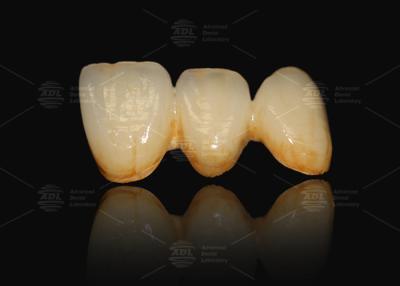 China A3 A3.5 Porcelana fundida a metal e coroa dental cerâmica à venda