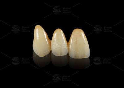 China Puente dental Emax Hipoalergénico y duradero en venta