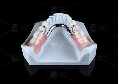 China Accesorios de precisión ERA multifuncionales ajustables Accesorios ERA extraíbles para dentaduras en venta