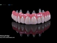 Hybrid Pink Porcelain Implant Crown Malong Full Arch Implant Bridge Immediate Loading