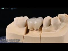 Natural Tooth Color Ceramic Feldspathic Veneer For Anterior And Posterior Teeth