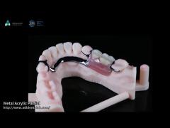 Removable Metal Acrylic Partial Denture With Clasps For Partial Chewing