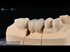 Natural Tooth Color Ceramic Feldspathic Veneer For Anterior And Posterior Teeth