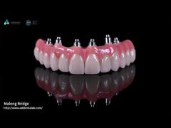 Hybrid Pink Porcelain Implant Crown Malong Full Arch Implant Bridge Immediate Loading