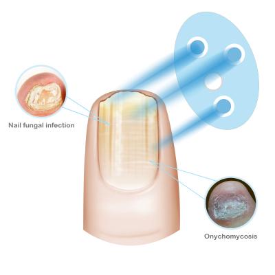 China Toe Nail Fungus Fungal Remover Onychomycosis Nail Infection Fungus Treatment Home Use Laser Therapy Device For Anti Fungus Nail Treatment for sale