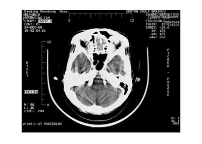 China Digital Printing Inkjet PET Medical X Ray Film With High Max Density & Bright Tone for sale