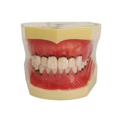 China Goods 28 Teeth Gently Bond Oral Surgery Periodontal Model to Demonstrate Calculus, Gum Receding and Measurement for sale