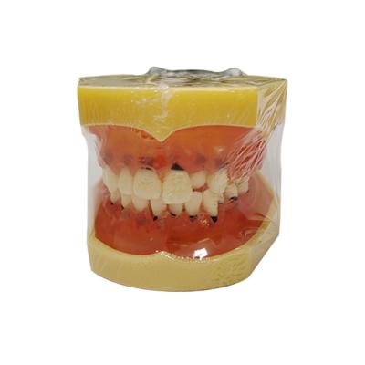 China Durable Educational Supplies Dental Training Gums Periodontal Disease Hard Model With Calculus for sale