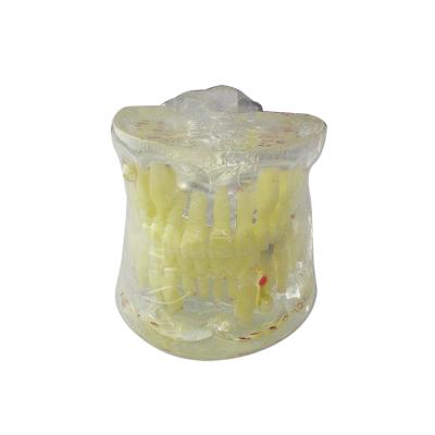 China Portable Transparent Caries Cyst and Firstula Pediatric Pathologies Model For Age 6-9 for sale