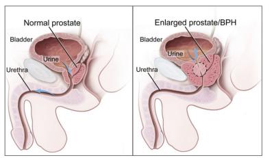 China Portable Painless Male Prostate Machine Electro Therapeutic Devices for sale