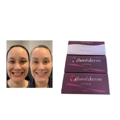 China Juvederm Preenchimento cutâneo injectável Juvederm Ultra3 Ultra4 Voluma à venda