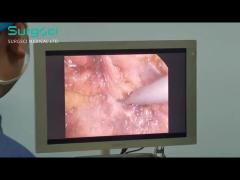 Using Ultrasonic Scalpel in Radical Rectal Cancer | SurgSci