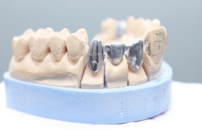 Cina Il metallo base dentario di alto carico di snervamento unisce in lega 12mm per il ponte facente fronte in vendita