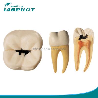 China Anatomical Model 16 Times Amplified Dental Caries Model for Education and Teaching for sale