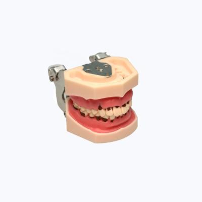 China School Training Model Peridontal Disease Model Pathology Display Dental Model for sale