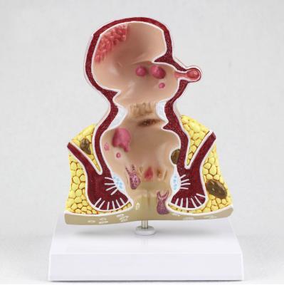 China Understanding rectal lesion Internal model of hemorrhoids of patients and external anatomy of hemorrhoids à venda