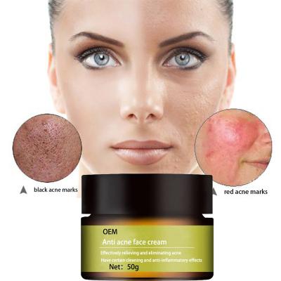 China OEM ODM Nourishing OWN To Mark Mango Natural Organic Blackhead Pimples Removal Anti Acne Scar Treatment Herbal Face Cream For Men Women for sale