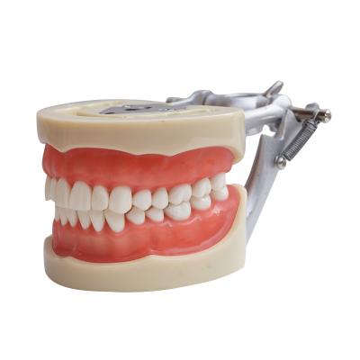 China Hot Selling Dental Digital Models 3d Models Dental Acupuncture Teaching Human Model 4 Periods Caries Pathology for sale