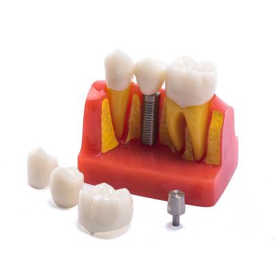 China Class III Instrument Classification Dental Study Model for Dental Practice and Demonstration for sale