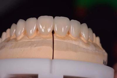 China 0.3mm IPS E.MAX Veneer Porcelain Veneers For Inlays Crowns And Veneers for sale