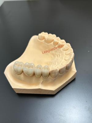 China Porcelana resistente a las manchas fusionada con metal Compatibilidad dental PFM corona en venta