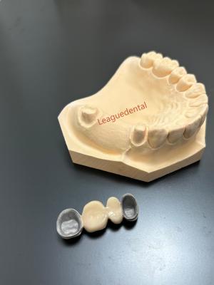 China Coroa de metal de porcelana de precisão Coroa PFM para restaurações dentárias duradouras à venda