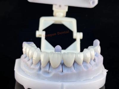 China 43%-46% Translucency PFZ Crown & Bridge Porcelain Fused To Zirconia Restorations for sale