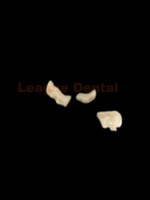 China High Strength Zirconia Inlay Natural Dental Inlay Onlay For Posterior Teeth for sale