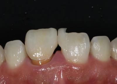 China Dientes anteriores Veneer de zirconia ultra delgado Veneer de alta translucidez en venta