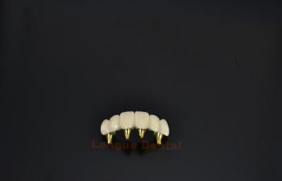 China Implantes Dentários de Titânio Personalizados Coroa Dentária Revitalize o Seu Sorriso à venda