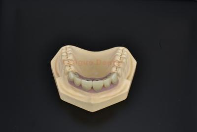 China Puente de implantes dentales de titanio natural para reemplazo de dientes perdidos en venta