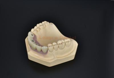 China Ceramic Cement Retained Implant Crown Dental Aesthetic Restoration Biocompatible for sale