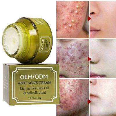 China Tea Tree Anti Aging Remover Brown Spot Pimples Scar Acne Face Cream Salicylic Acid OEM/ODM Anti Acne Cream for sale