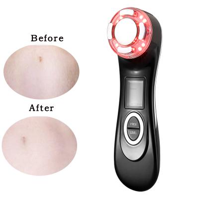 China Mental Anti-Puffiness RF Laser Remove Stretch Marks Creative Products To Remove Stretch Marks Beauty Machine for sale