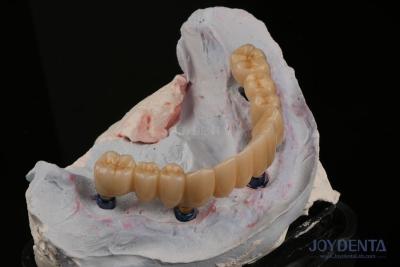 China Dental Restorations Multiple Teeth Implant Endosseous Replace Two Front Teeth for sale