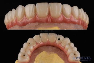 China Plataforma de implantes dentales de superficie áspera Puentes dentales con conexión interna en venta